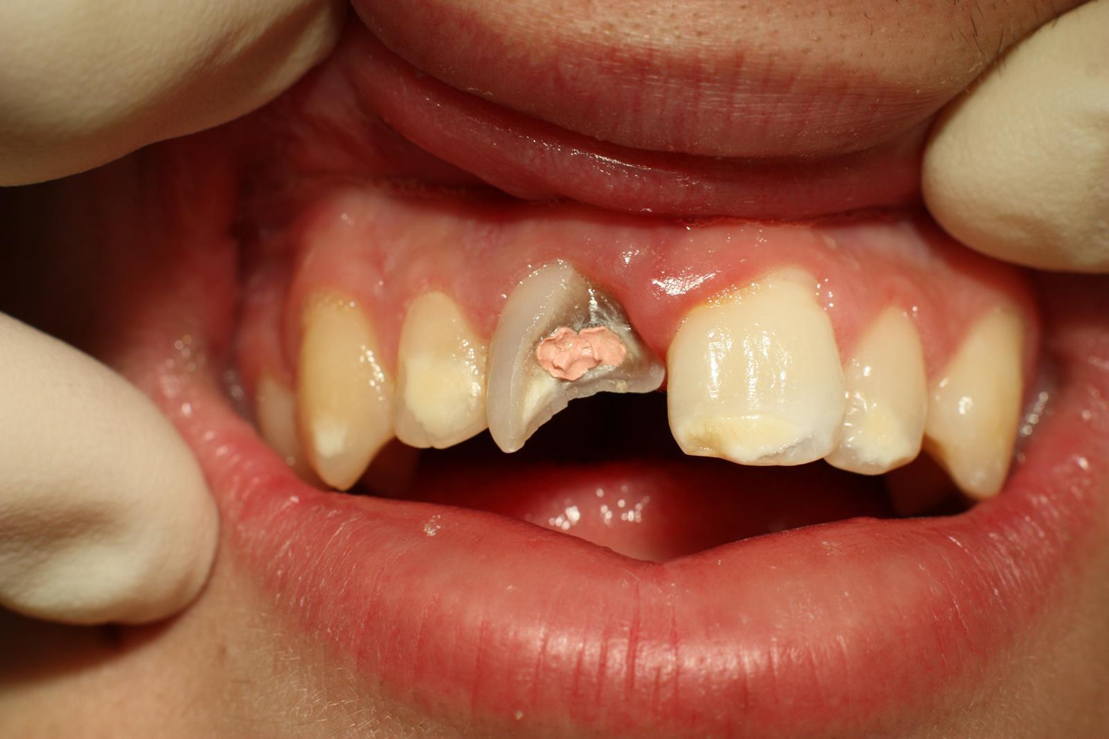 Pode you fazer um tratamento de canal com um dente lascado? - Oclean