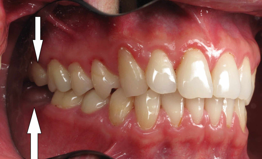 A remoção dos dentes posteriores afeta a deglutição?