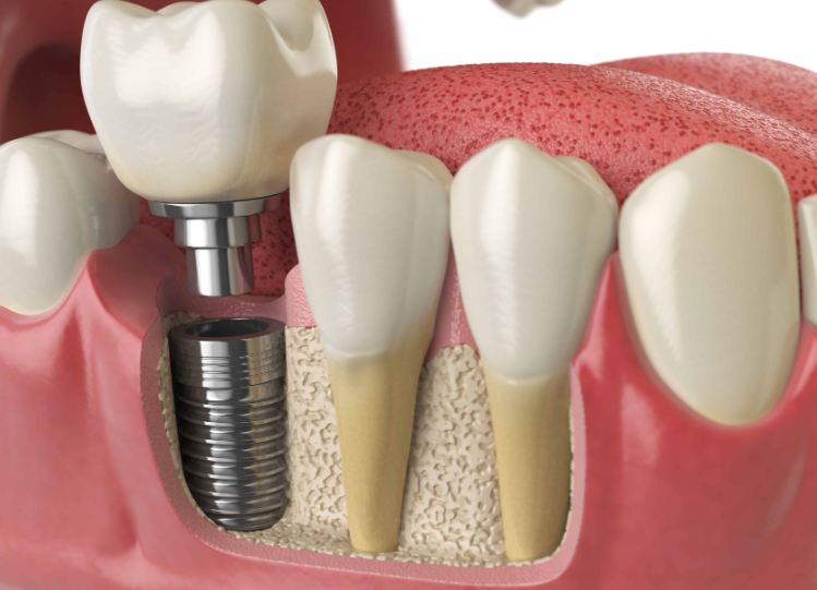 Quanto custam os implantes dentários?