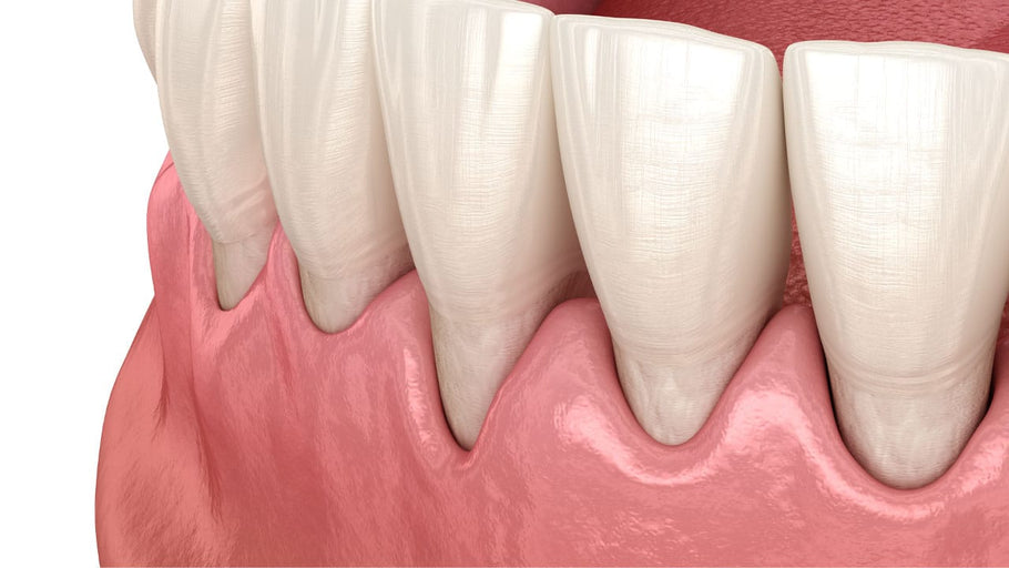 Os Escovas de Dentes Sónicas São Boas para Gengivas Recedidas?