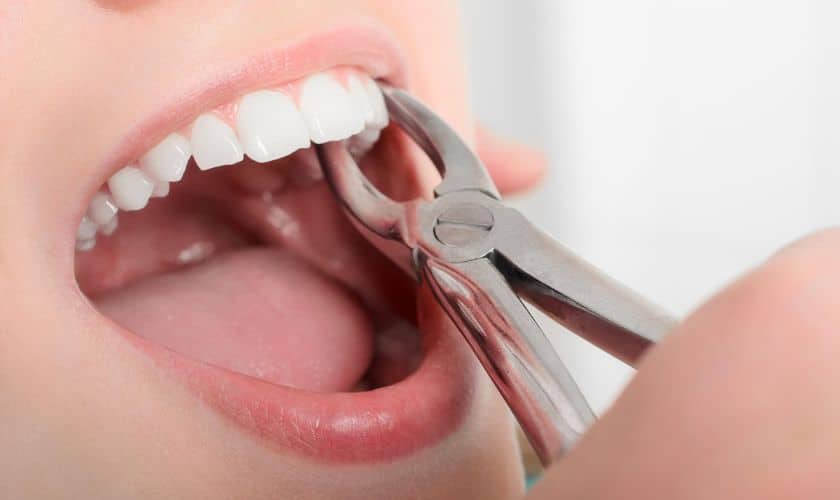 Quanto Tempo Demora a Cicatrizar uma Extração Dentária?