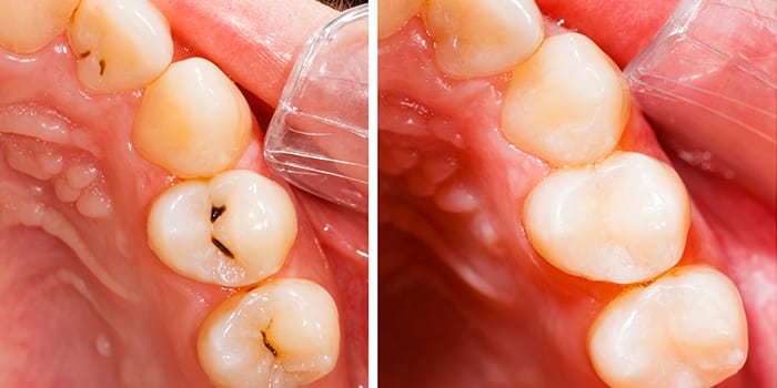 Quanto tempo depois de um enchimento posso escovar os dentes?