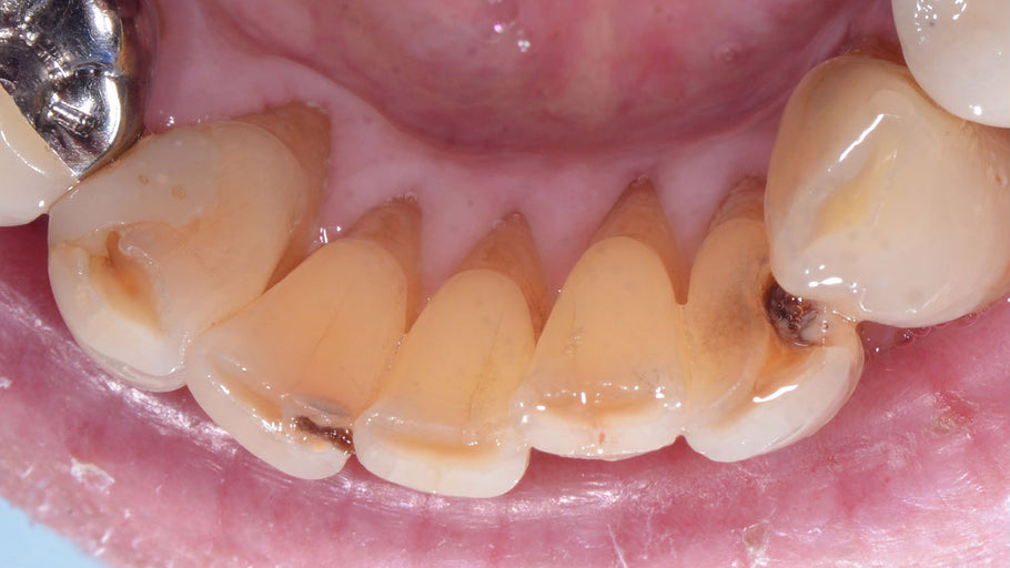 Uma raiz de dente exposta pode causar visão dupla?